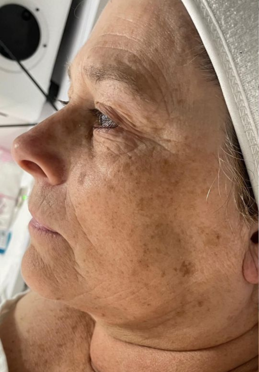 before and after collagen lift for uneven skin tone Katherine Monique Beauty