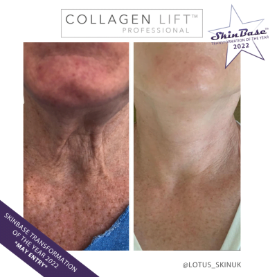 LOTUS SKIN COLLAGEN LIFT TREATMENT