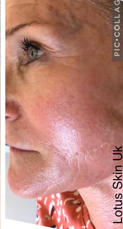 before and after collagen lift lotus skin uk