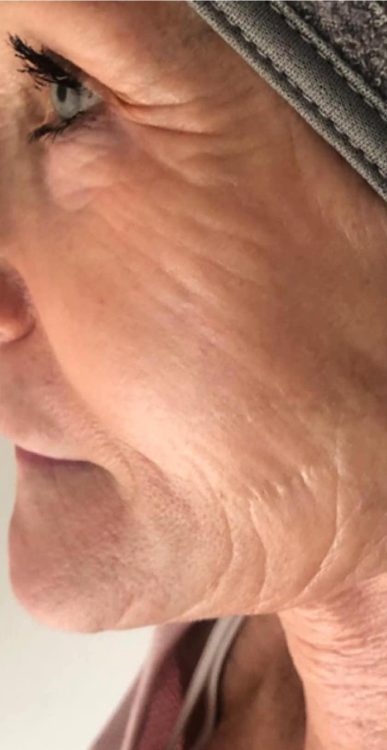 before and after collagen lift lotus skin uk