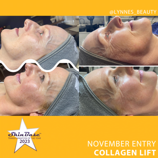November Collagen Lift Entries November Collagen Lift Entries LYNNESBEAUTY