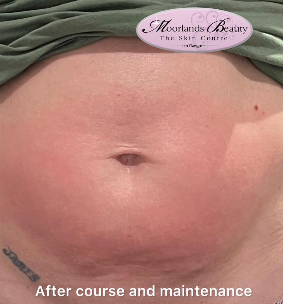 before and after collagen lift moorlands beauty