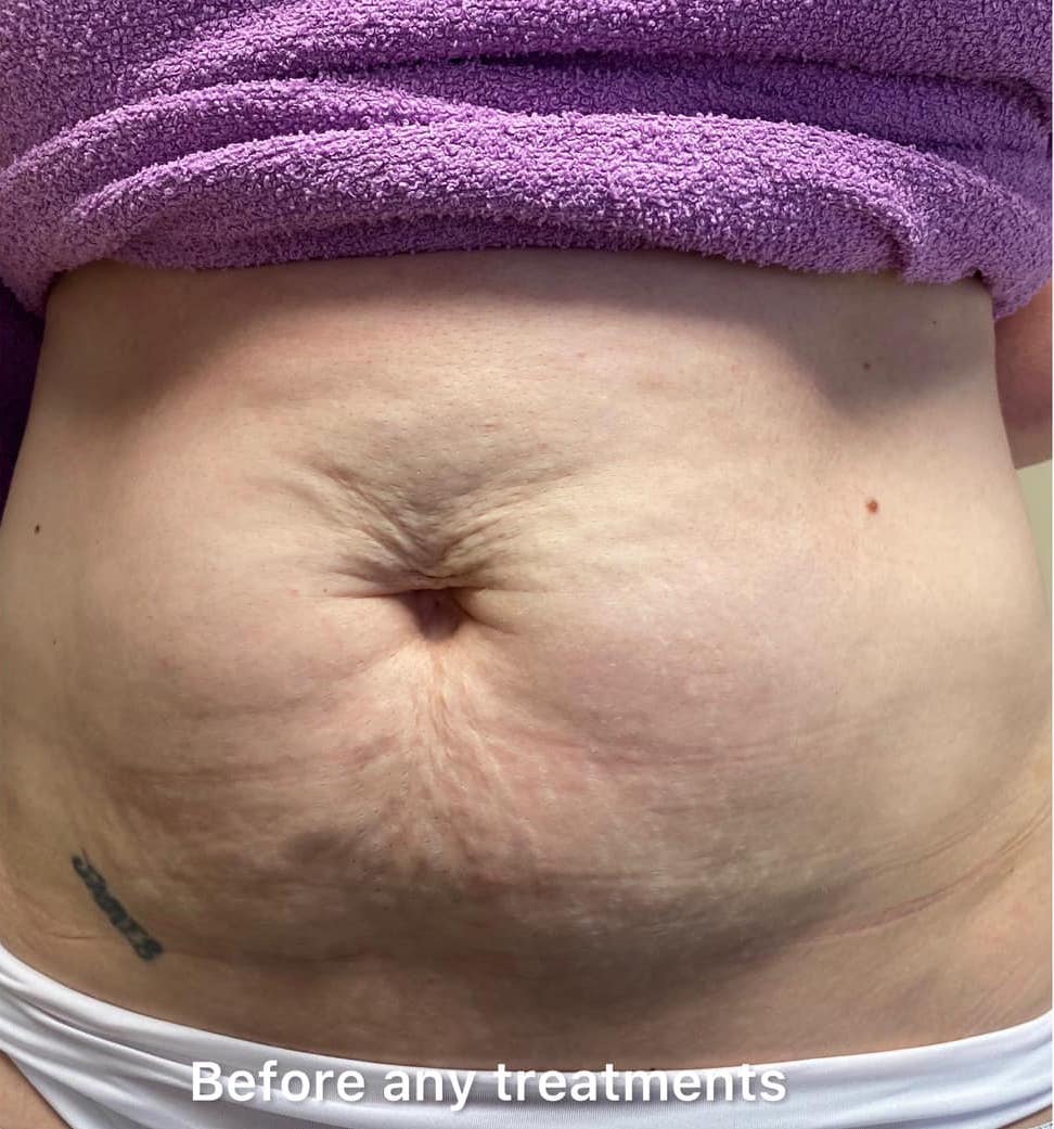 before and after collagen lift moorlands beauty