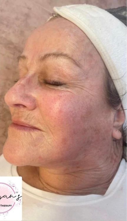 before and after collagen lift Morgan's beauty therapy