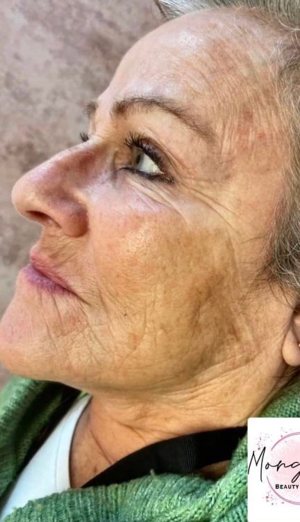 before and after collagen lift Morgan's beauty therapy