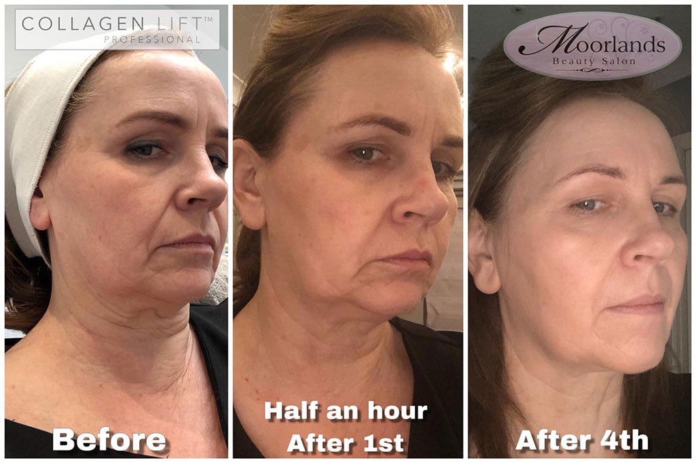 Collagen Lift results – Be warned, you’re going to want this treatment! Moorlands Beauty Salon