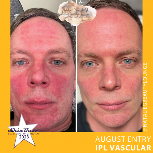 IPL for Rosacea IPL for Rosacea