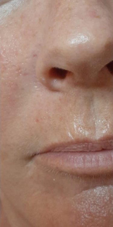 before and after microdermabrasion natural glow beauty