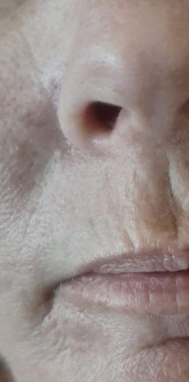 before and after microdermabrasion natural glow beauty
