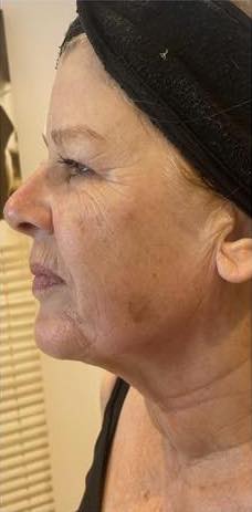 before and after collagen lift naturally beautiful