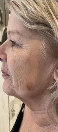 before and after collagen lift naturally beautiful