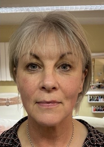 before and after collagen lift nu u beauty