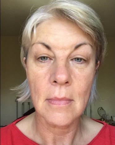before and after collagen lift nu u beauty