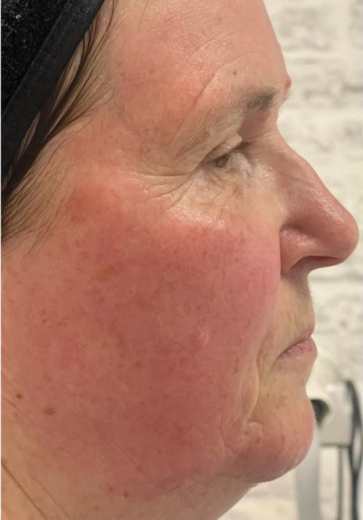 before and after collagen lift for uneven skin tone Natalie Greenhalgh