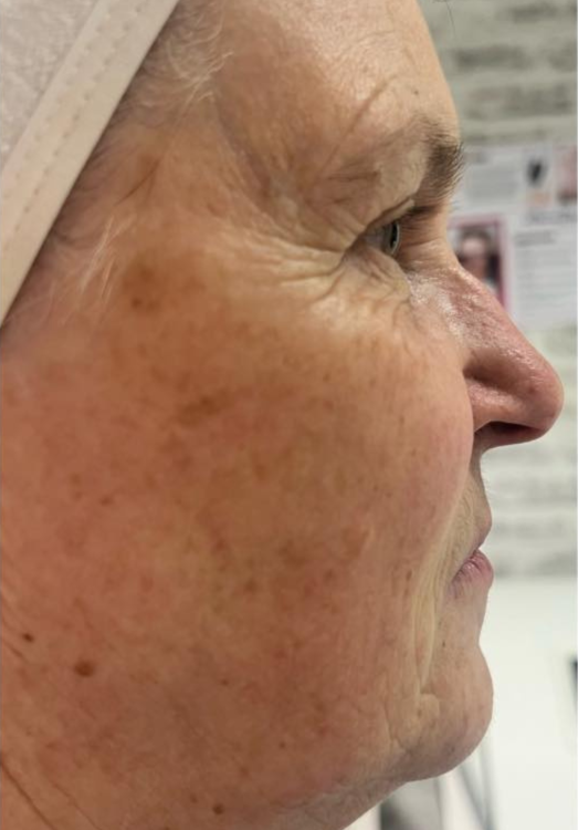 before and after collagen lift for uneven skin tone Natalie Greenhalgh