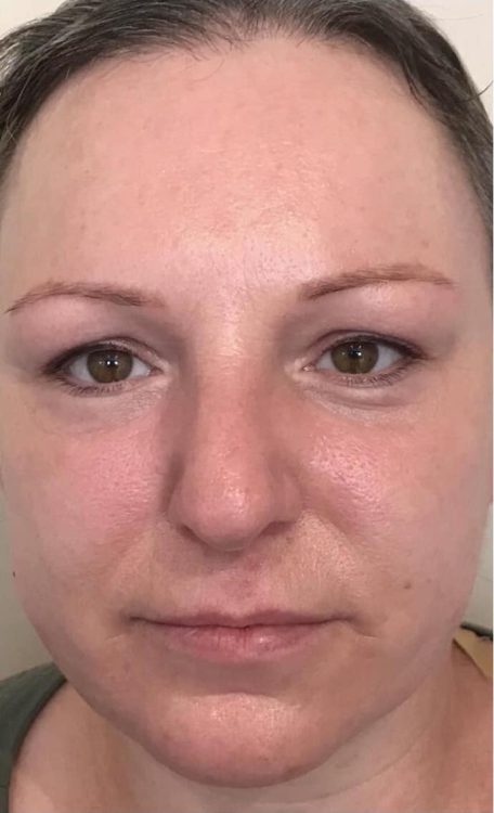 before and after microdermabrasion for acne pamper treat repeat