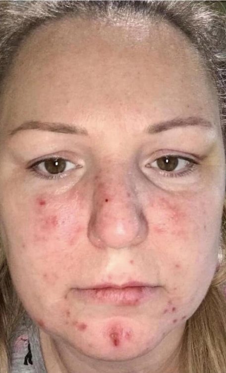 before and after microdermabrasion for acne pamper treat repeat
