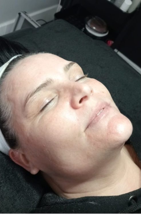 before and after microdermabrasion peak beauty performance