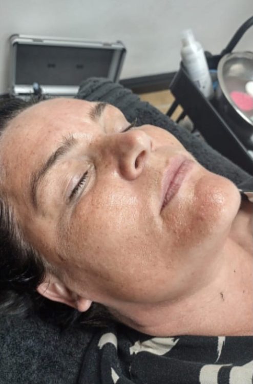 before and after microdermabrasion peak beauty performance