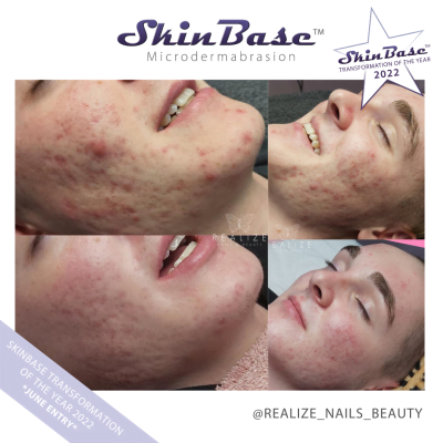 microdermabrasion acne before and after