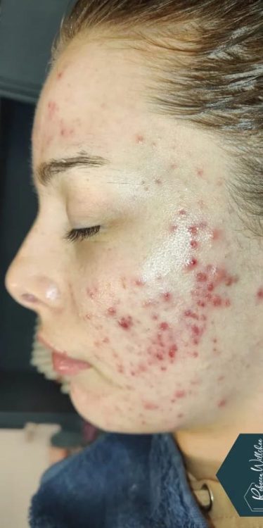 before and after microdermabrasion for acne Rebecca Willshee
