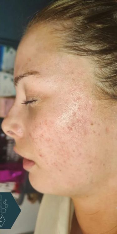 before and after microdermabrasion for acne Rebecca Willshee