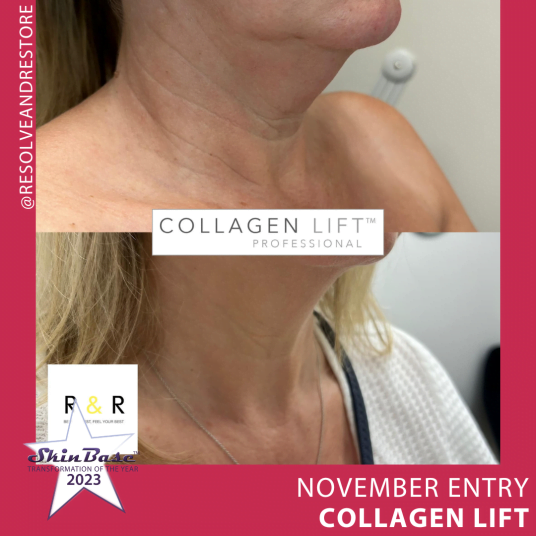 November Collagen Lift Entries November collagen lift entries: Resolve and Restore