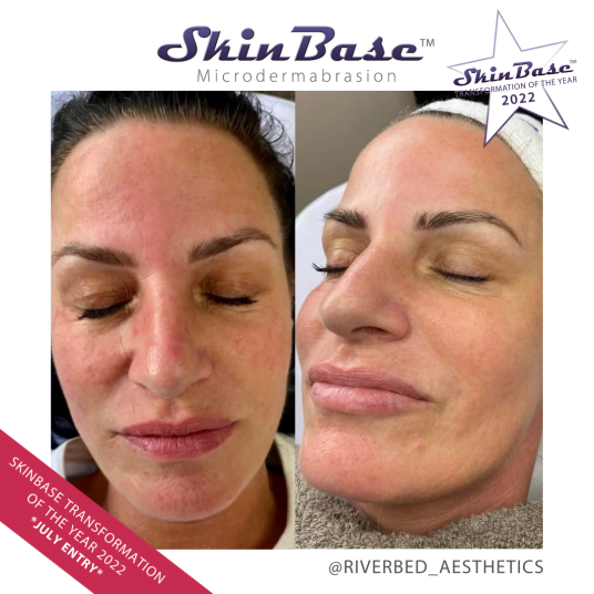 microdermabrasion transformations RIVERBEDAESTHETICS microdermabrasion transformations RIVERBEDAESTHETICS