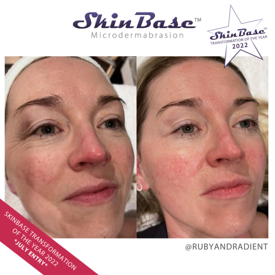 RUBYANDRADIENT FACIAL TRANSFORMATION RUBYANDRADIENT FACIAL TRANSFORMATION