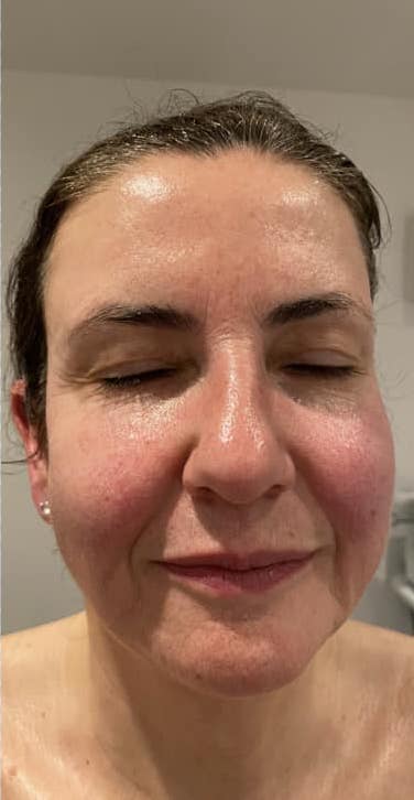 before and after collagen lift serenity beauty
