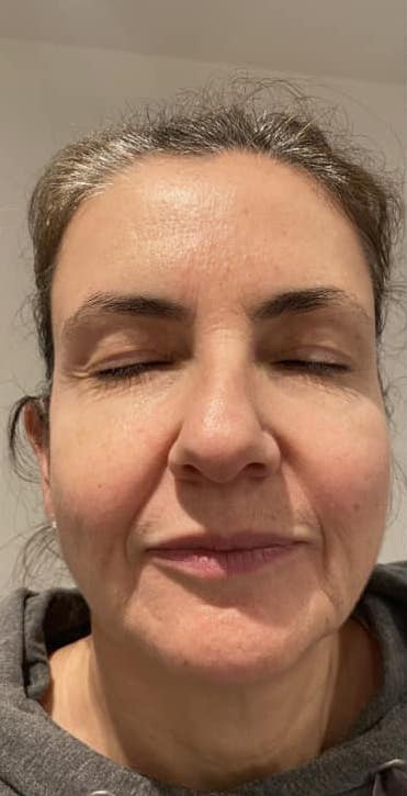 before and after collagen lift serenity beauty