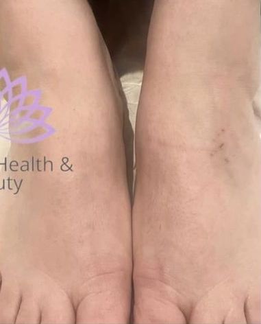 before and after IPL Hair Reduction serenity health and beauty