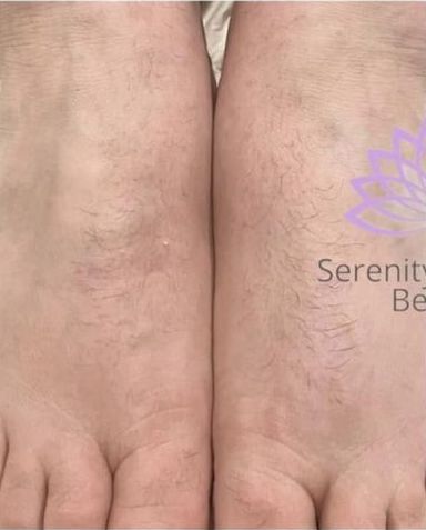 before and after IPL Hair Reduction serenity health and beauty