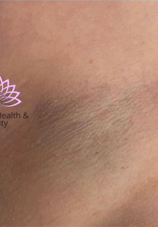 before and after IPL serenity health and beauty