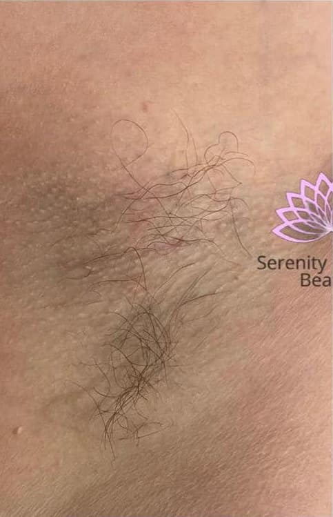 before and after IPL serenity health and beauty
