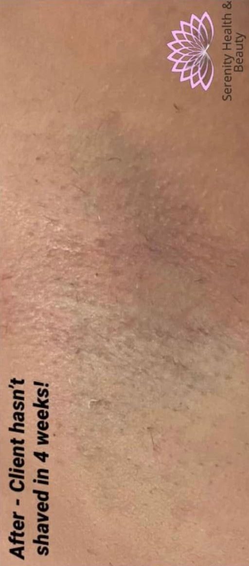 before and after ipl hair reduction serenity health and beauty