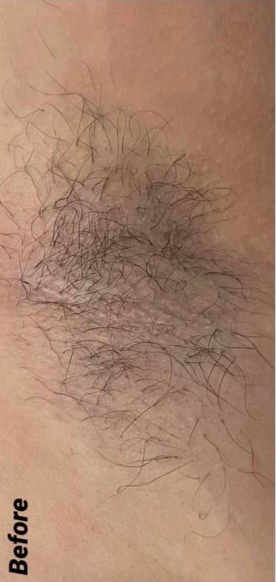before and after ipl hair reduction serenity health and beauty