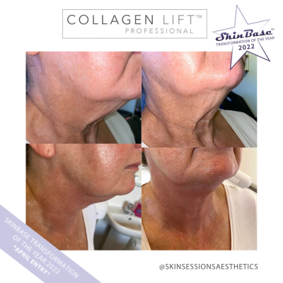 Skin sessions CL Before and after