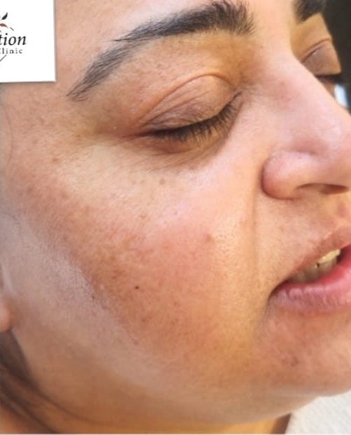 before and after microdermabrasion solution skin clinic