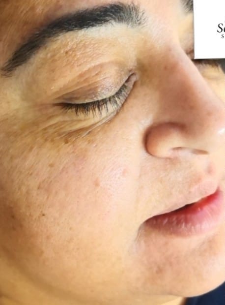 before and after microdermabrasion solution skin clinic