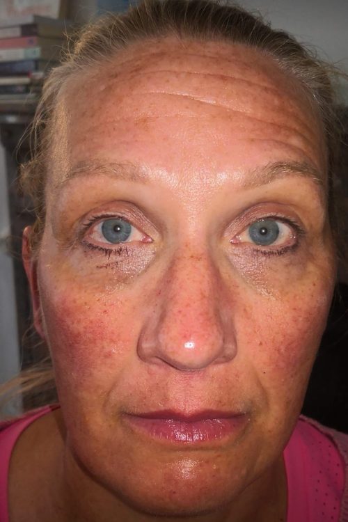 before and after microdermabrasion solution skin clinic