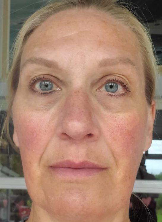 before and after microdermabrasion solution skin clinic