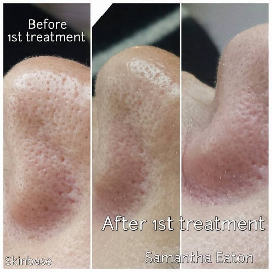Blocked Pores, Samantha Eaton