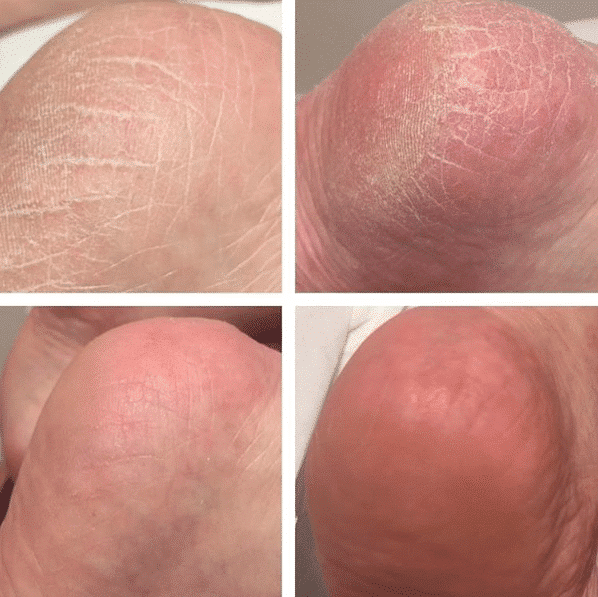 SkinBase microdermabrasion for your feet - SkinBase