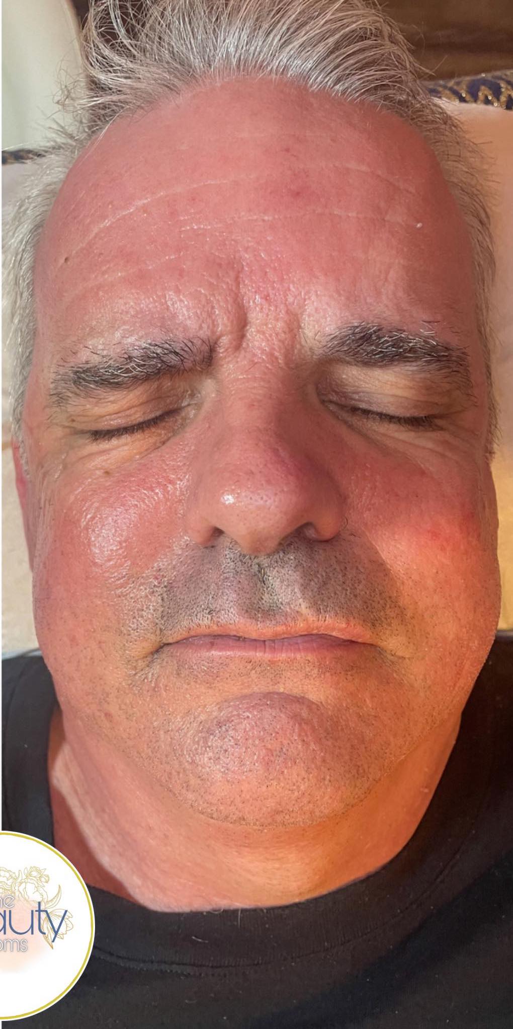 microdermabrasion before and after the beauty rooms