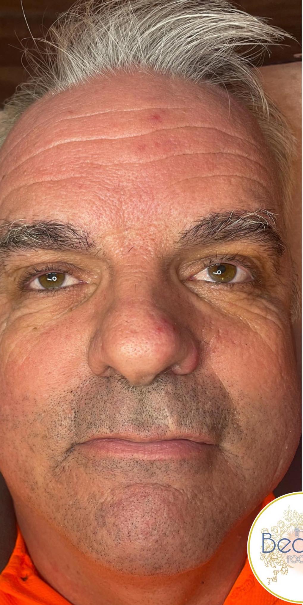 microdermabrasion before and after the beauty rooms