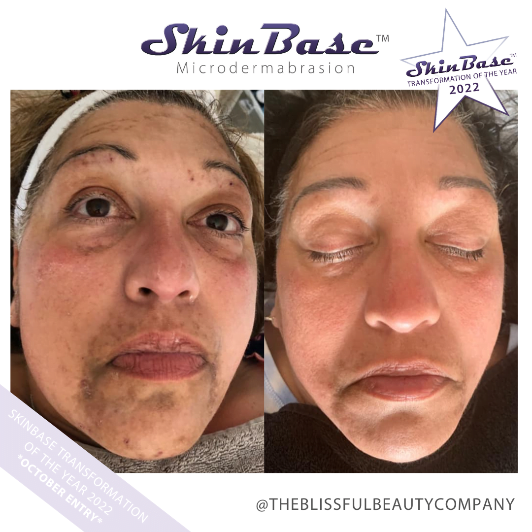 pigmentation before and after
