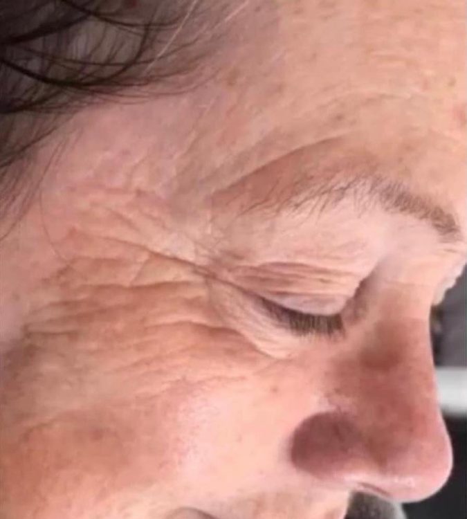 before and after collagen lift the blissful beauty company