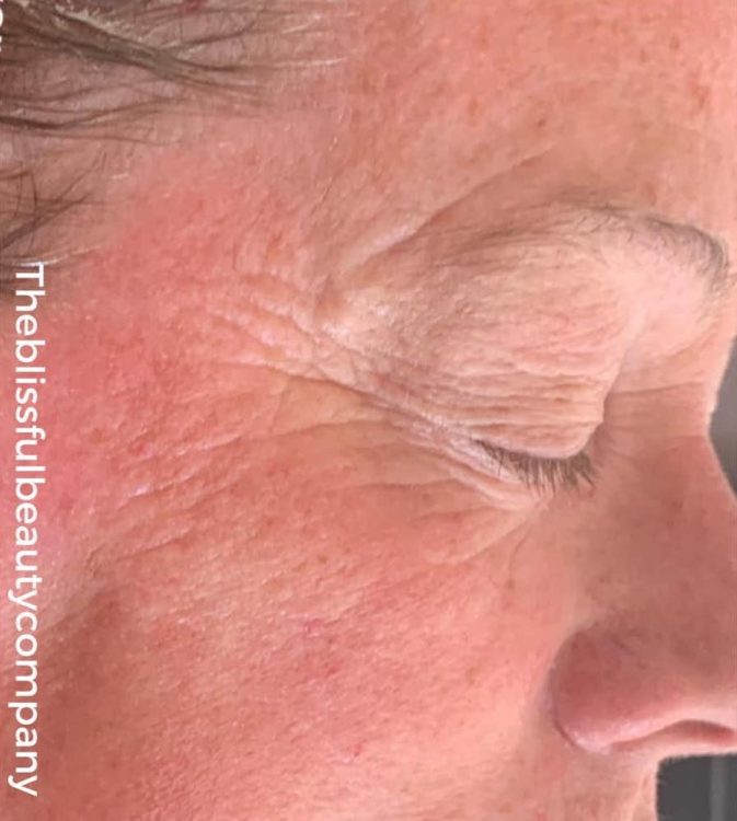 before and after collagen lift the blissful beauty company