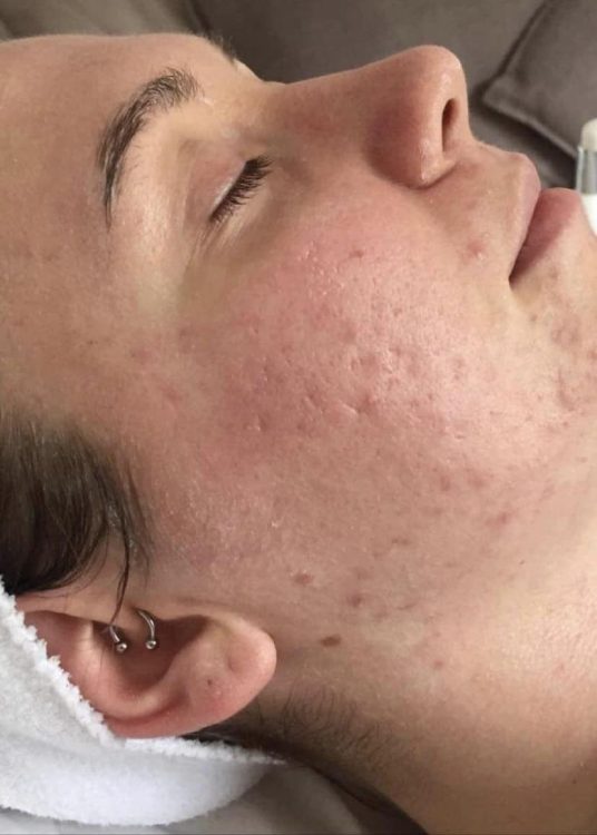 before and after microdermabrasion the blissful beauty company